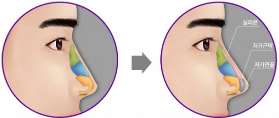 Nâng mũi bọc sụn tự thân có thể bảo vệ đầu mũi