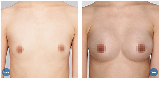 Hình ảnh khách hàng trước và sau khi nâng ngực nội soi