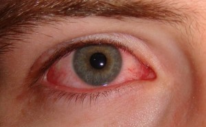 ngứa mí mắt là bệnh gì 4
