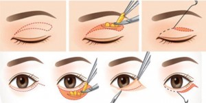 phẫu thuật lấy mỡ mí mắt và cắt da thừa 2