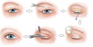 Những câu hỏi thường gặp liên quan đến giai đoạn sau khi cắt mí mắt 1