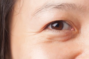 Hiểu tác hại của bọng mỡ mắt để biết có nên cắt bọng mỡ mắt hay không 2