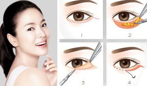 Hiểu tác hại của bọng mỡ mắt để biết có nên cắt bọng mỡ mắt hay không 3