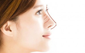 1001 câu hỏi về nâng mũi bằng sụn tự thân 1