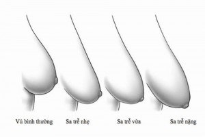 Hỏi – Đáp một số vấn đề của nâng ngực sa trễ, nâng ngực sa trễ sau sinh 1