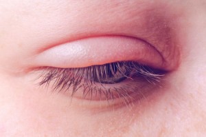 Nguyên nhân, cách chữa mí mắt bị sưng và nhức 1