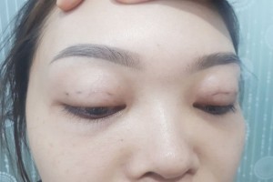 Cách giải quyết những tác hại của việc nhấn mí mắt 1