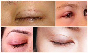 Cách giải quyết những tác hại của việc nhấn mí mắt 2