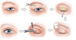 Lợi và hại của cắt mí mắt giá rẻ 2