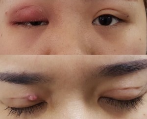 Nguyên nhân dẫn đến tác hại của việc nhấn mí mắt 2