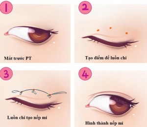So sánh các cách tạo mắt 2 mí không phẫu thuật với phẫu thuật 3