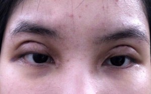 Nguyên nhân dẫn đến tác hại của việc nhấn mí mắt 3