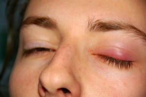 Nguyên nhân, cách chữa mí mắt bị sưng và nhức 3