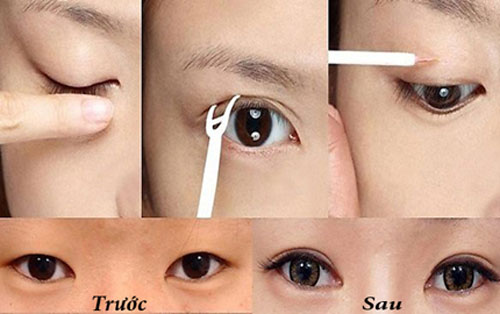So sánh các cách tạo mắt 2 mí không phẫu thuật với phẫu thuật 2