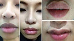 Có nên phẫu thuật làm mỏng môi hay không? 3